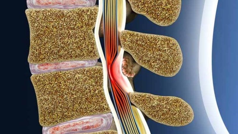 Hẹp ống sống thắt lưng khiến tủy sống hoặc các rễ thần kinh bị chèn ép