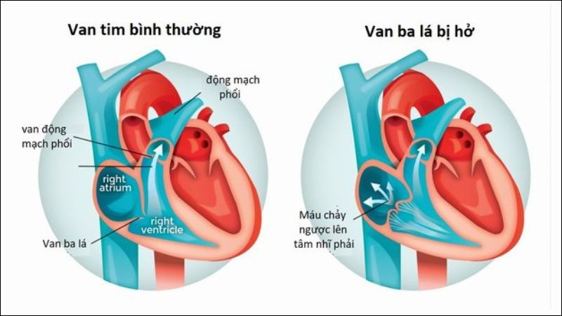 Khi van ba lá bị hở sẽ gây nên tình trạng máu phụt ngược từ tâm thất phải lên tâm nhĩ phải