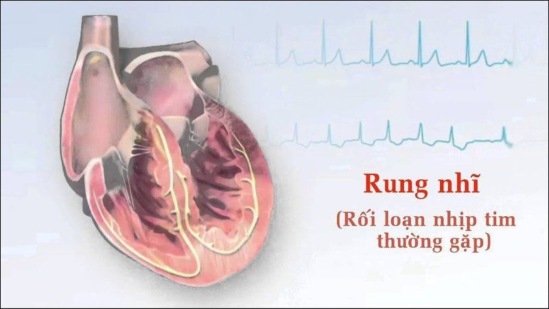 Biến chứng có thể gặp của hở van ba lá nặng là rung tâm nhĩ