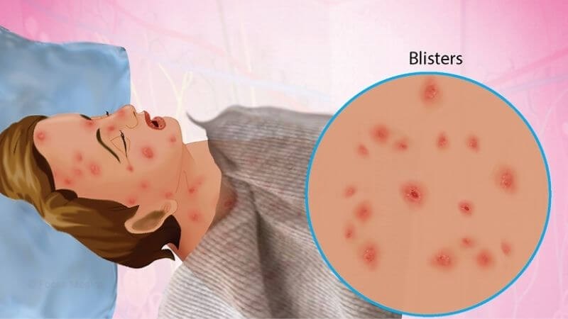 Hội chứng Steven Johnson (SJS) là phản ứng dị ứng trên da và niêm mạc nghiêm trọng.