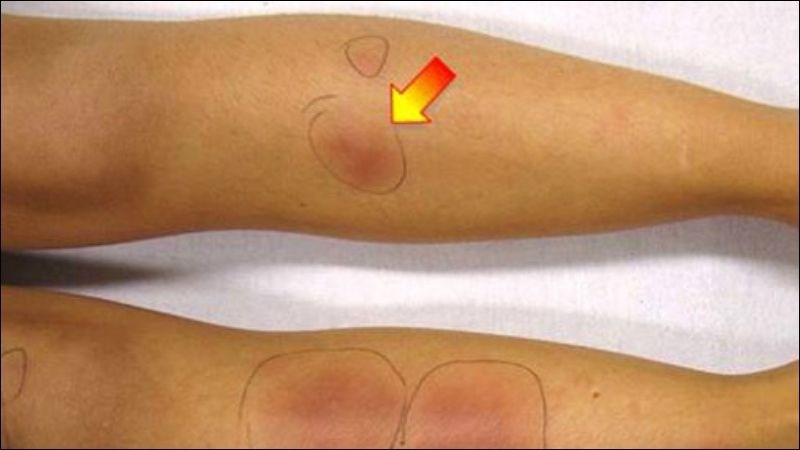 Hồng ban nút là tình trạng xuất hiện sẩn màu đỏ trên mặt trước chân