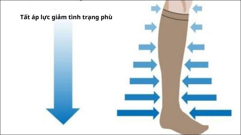 Sử dụng tất áp lực để giảm cảm giác phù