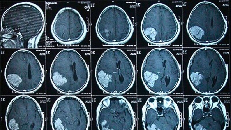 Chụp CT sọ não để phát hiện các tổn thương vùng đầu