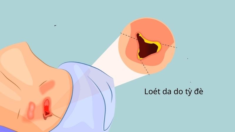 Loét da là tình trạng da lở loét do hạn chế dinh dưỡng đến da