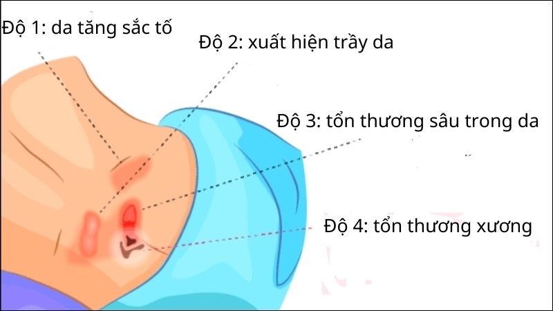Các giai đoạn của loét da do tì đè