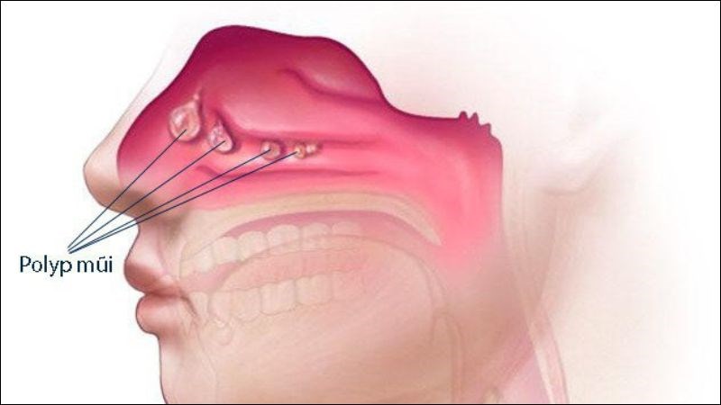 Polyp mũi là những khối u mềm tồn tại trong khoang mũi Polyp mũi là những khối u mềm tồn tại trong khoang mũi