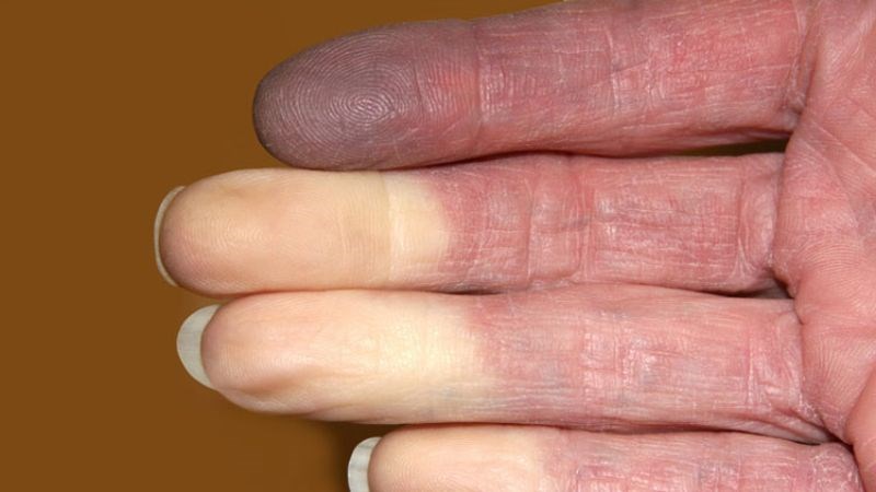 Hội chứng Raynaud là tình trạng ngón tay, ngón chân lạnh, tê cứng