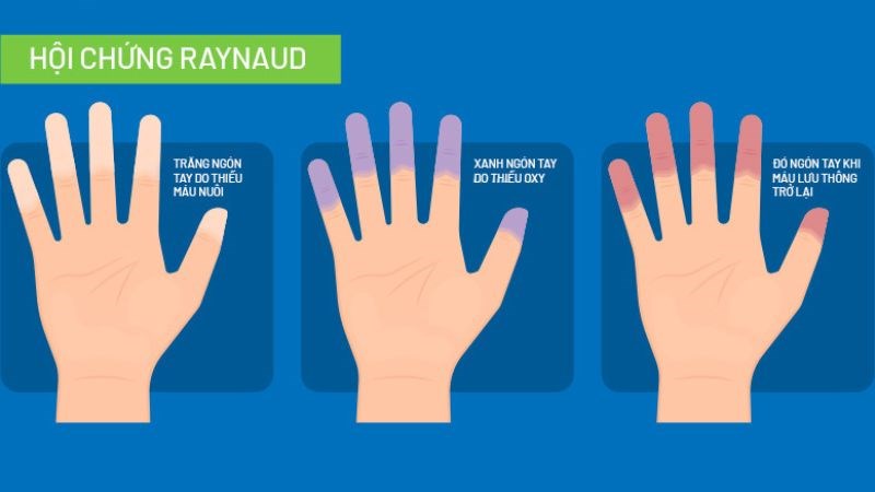 Sự thay đổi màu sắc ngón tay trong hội chứng raynaud