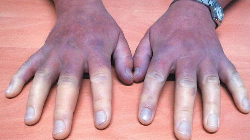 Khi hội chứng raynaud nặng cần đến bệnh viện để thăm khám