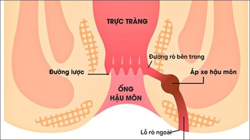 Rò hậu môn là tình trạng xuất hiện lỗ bất thường ở da vùng hậu môn