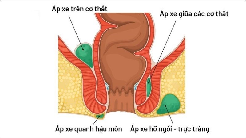 Áp xe vùng hậu môn là nguyên nhân chính gây nên tình trạng rò hậu môn