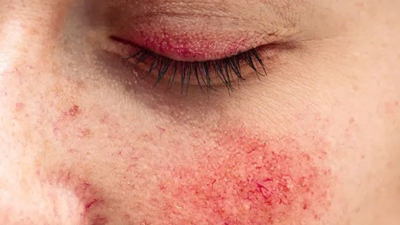 Bệnh rosacea là bệnh viêm da mạn tính Bệnh rosacea là bệnh viêm da mạn tính