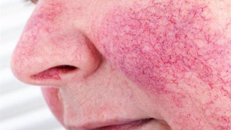 Rosacea phì đại hiếm gặp và thường là triệu chứng nghiêm trọng của bệnh Rosacea phì đại hiếm gặp và thường là triệu chứng nghiêm trọng của bệnh