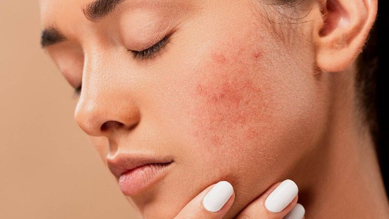 Hồng ban kéo dài là những triệu chứng đầu tiên của bệnh rosacea Hồng ban kéo dài là những triệu chứng đầu tiên của bệnh rosacea