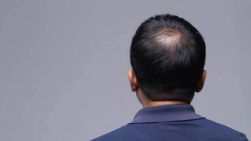 Tóc mỏng dần từ trên đỉnh đầu