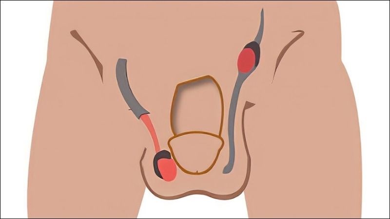Tinh hoàn ẩn là một trong những nguyên nhân gây teo tinh hoàn Tinh hoàn ẩn là một trong những nguyên nhân gây teo tinh hoàn