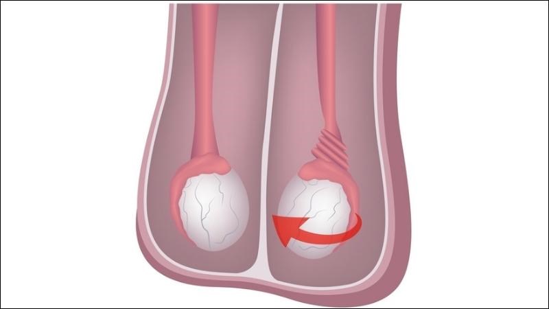 Bệnh teo tinh hoàn: Nguyên nhân, dấu hiệu và cách điều trị