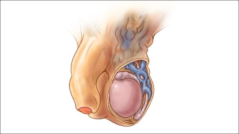 Giãn tĩnh mạch thừng tinh gây ảnh hưởng nhiều đến sức khỏe sinh sản ở nam giới Giãn tĩnh mạch thừng tinh gây ảnh hưởng nhiều đến sức khỏe sinh sản ở nam giới