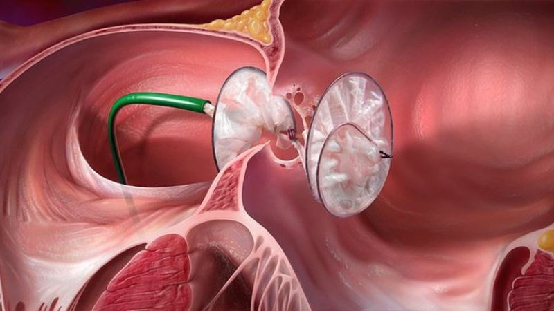 Thông tim được sử dụng để bít lỗ thủng trong điều trị thông liên thất Thông tim được sử dụng để bít lỗ thủng trong điều trị thông liên thất