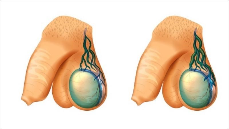 Tràn dịch màng tinh hoàn là tình trạng tích tụ chất lỏng bên trong bìu