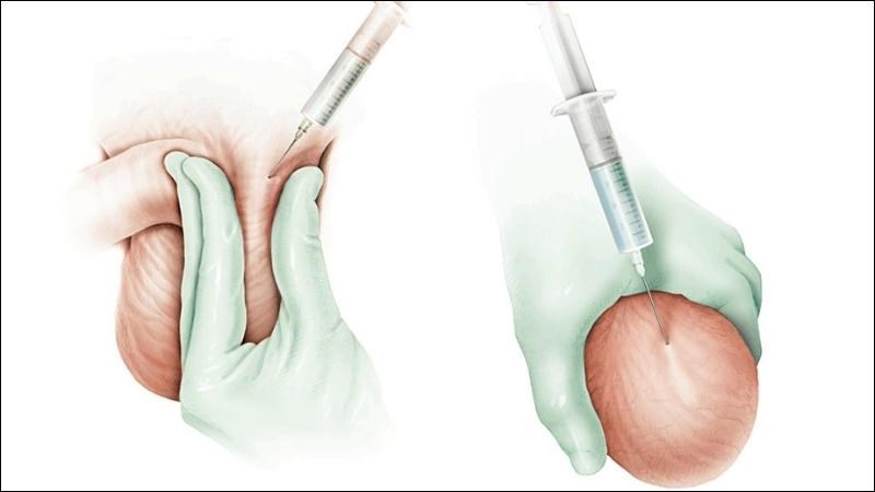 Dẫn lưu dịch tinh hoàn áp dụng đối với bệnh nhân không đủ sức khỏe để phẫu thuật