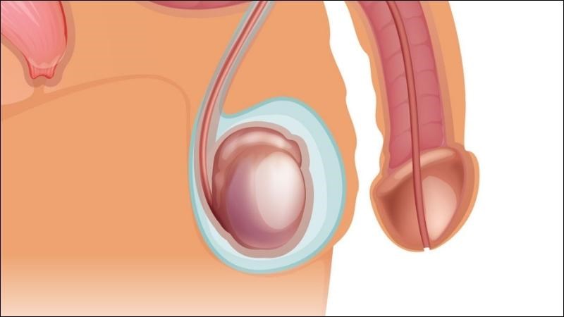 Dấu hiệu tràn dịch màng tinh hoàn chủ yếu là sưng phù ở bìu