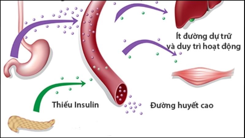 Đái tháo đường tuýp 1 là tình trạng tuyến tuỵ suy yếu nên không sản xuất được insulin Đái tháo đường tuýp 1 là tình trạng tuyến tuỵ suy yếu nên không sản xuất được insulin