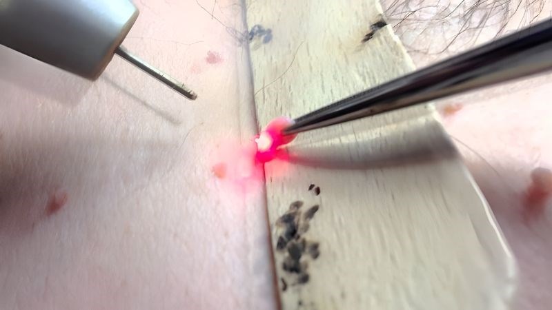 U mềm lây lây qua đường nào