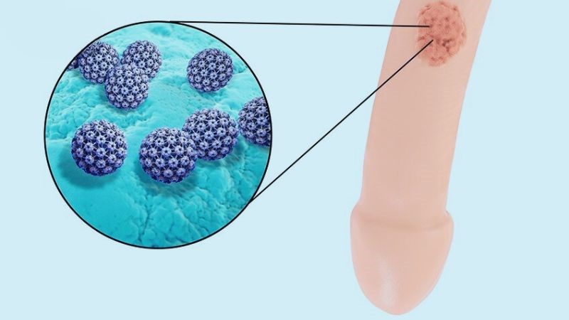 Ung thư biểu mô tế bào vảy là một dạng ung thư da phổ biến