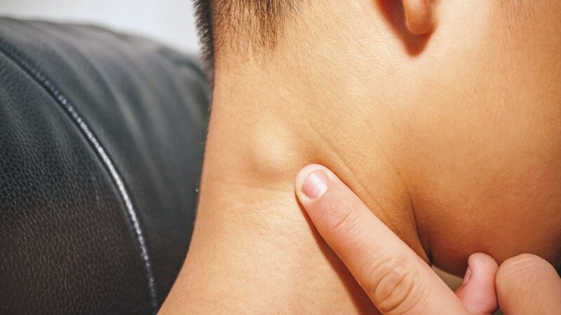 Sưng hạch ở cổ là triệu chứng điển hình của ung thư hạch