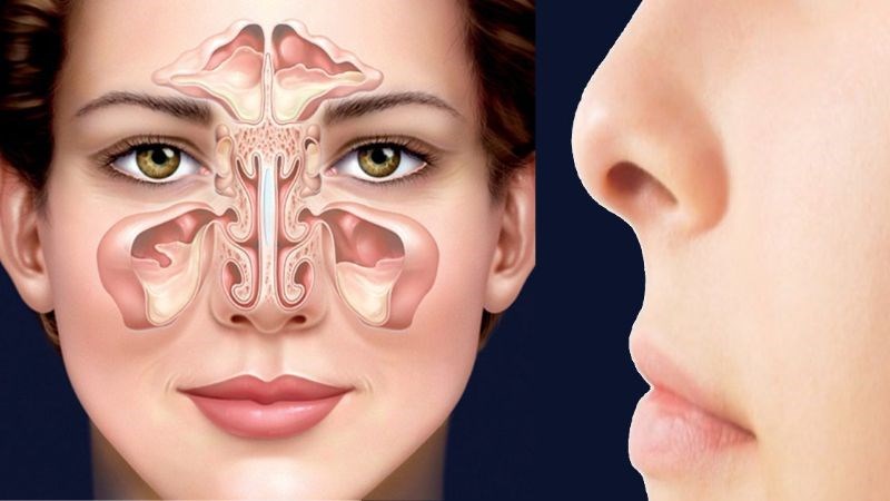 Ung thư mũi xoang là sự phát triển các khối u ác tính trong khoang mũi và xoang vùng mặt