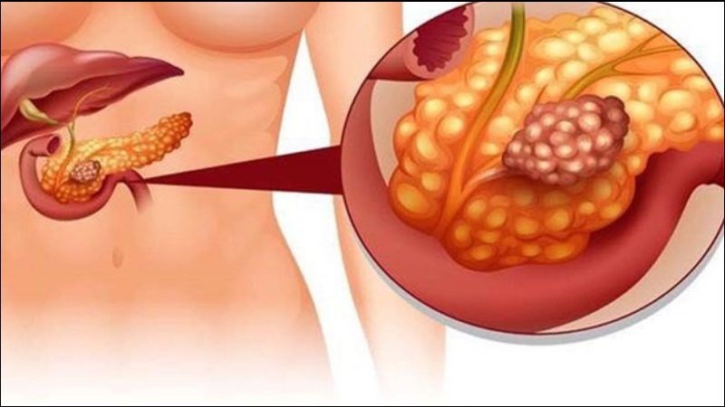 Ung thư tuyến tụy là sự phát triển không kiểm soát của tế bào tuyến tụy