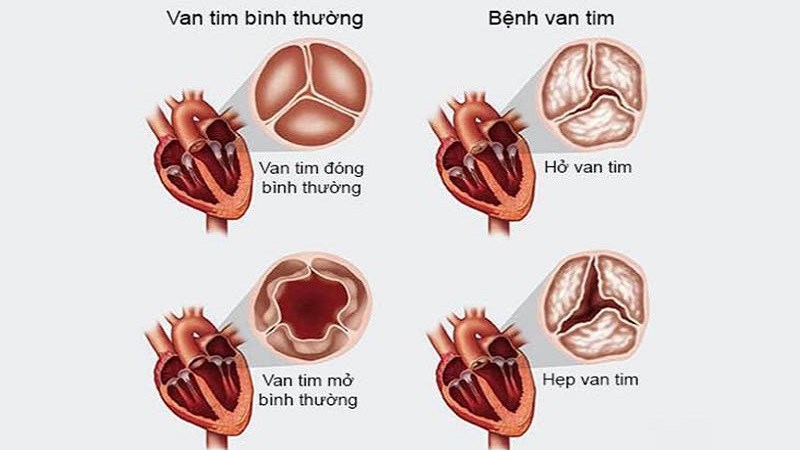 Tổn thương van tim là biến chứng thường gặp nhất ở bệnh nhân thấp tim Tổn thương van tim là biến chứng thường gặp nhất ở bệnh nhân thấp tim
