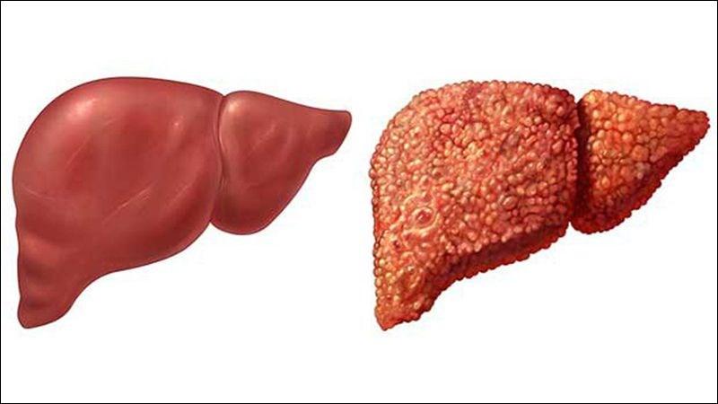 Viêm gan mạn tính có thể hình thành tình trạng xơ gan