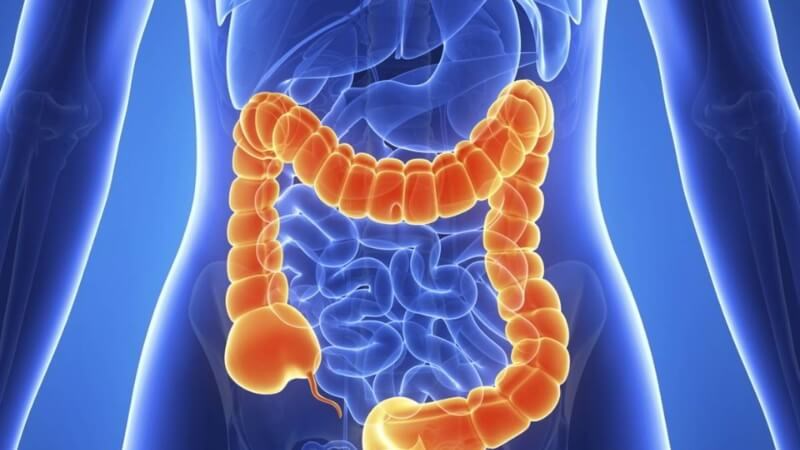 Bệnh Crohn có thể gây biến chứng ung thư ruột kết
