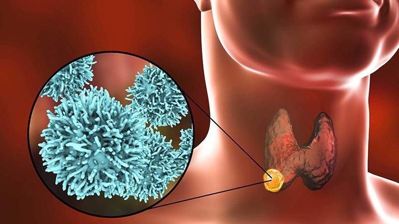 Các tác nhân tác động vào tuyến giáp gây nên tình trạng viêm