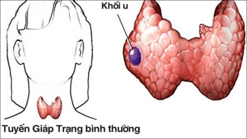 Viêm tuyến giáp có thể phát triển thành khối u