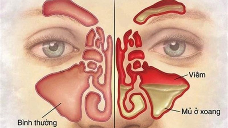 Viêm xoang kéo dài trên 3 tháng là viêm xoang mạn tính