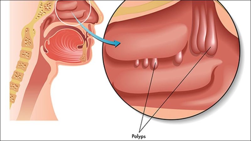 Người có polyp mũi sẽ dễ bị mắc viêm xoang mạn tính hơn