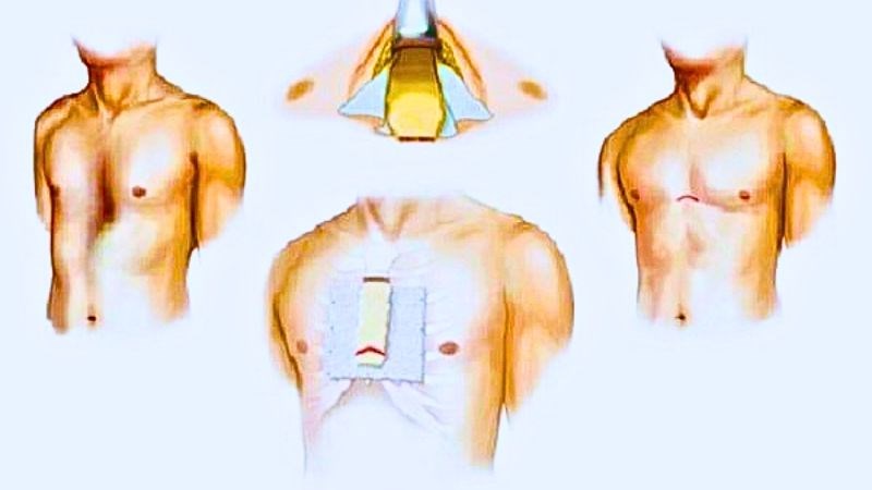 Phẫu thuật thường được chỉ định khi gãy xương nặng hoặc biến dạng nghiêm trọng