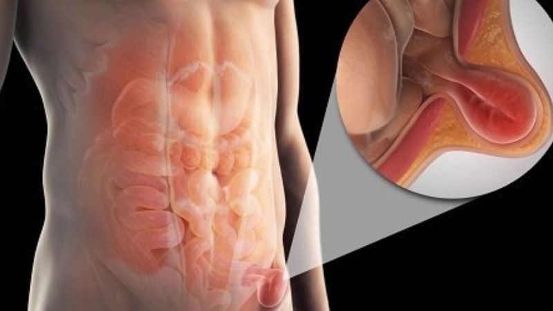 Thoát vị bẹn là tình trạng khi mô mỡ hoặc một phần ruột lấn vào vùng háng phía trên đùi Thoát vị bẹn là tình trạng khi mô mỡ hoặc một phần ruột lấn vào vùng háng phía trên đùi