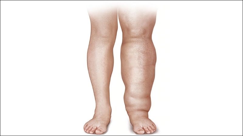 Bệnh chân voi là bệnh gây nên sưng đau, biến dạng chân
