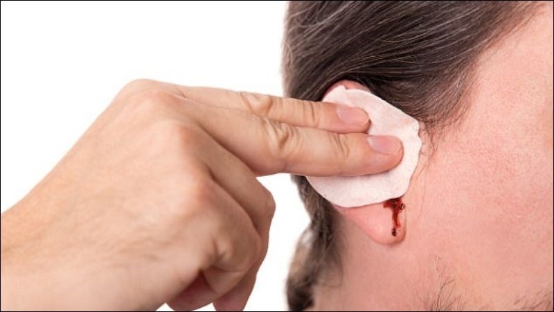 Chảy máu tai là hiện tượng xuất huyết từ bất kỳ vị trí nào của tai Chảy máu tai là hiện tượng xuất huyết từ bất kỳ vị trí nào của tai