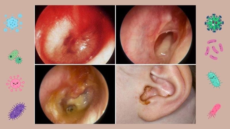 Viêm tai chảy máu: Dấu hiệu nguy hiểm và các phương pháp điều trị hiệu quả