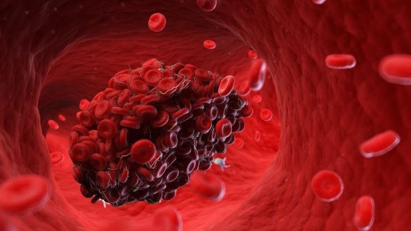 Quá nhiều hồng cầu trong máu sẽ dễ hình thành cục máu đông Quá nhiều hồng cầu trong máu sẽ dễ hình thành cục máu đông