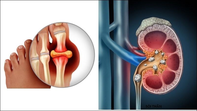 Nồng độ acid uric tăng gây ra bệnh gút và sỏi thận Nồng độ acid uric tăng gây ra bệnh gút và sỏi thận
