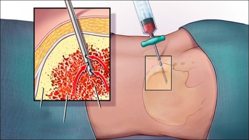 Sinh thiết tủy xương giúp khảo sát được chức năng và cấu tạo tủy xương Sinh thiết tủy xương giúp khảo sát được chức năng và cấu tạo tủy xương