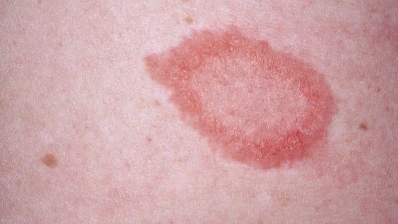 Vảy phấn hồng là một bệnh lý ngoài da với các mảng vảy đỏ nằm rải rác trên cơ thể