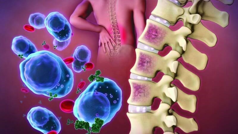 Đa u tủy xương là loại ung thư máu gây tăng sinh ác tính các tương bào Đa u tủy xương là loại ung thư máu gây tăng sinh ác tính các tương bào