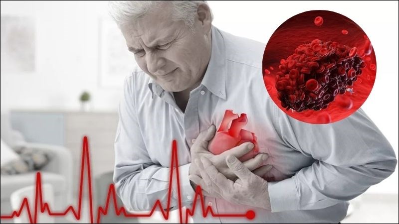 Thuốc chống đông máu là rất cần thiết đối với cơn đau ngực do nhồi máu